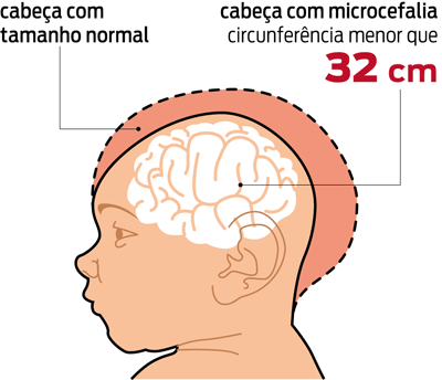  No Recife, mães de filhos com microcefalia reclamam de falta de apoio do estado